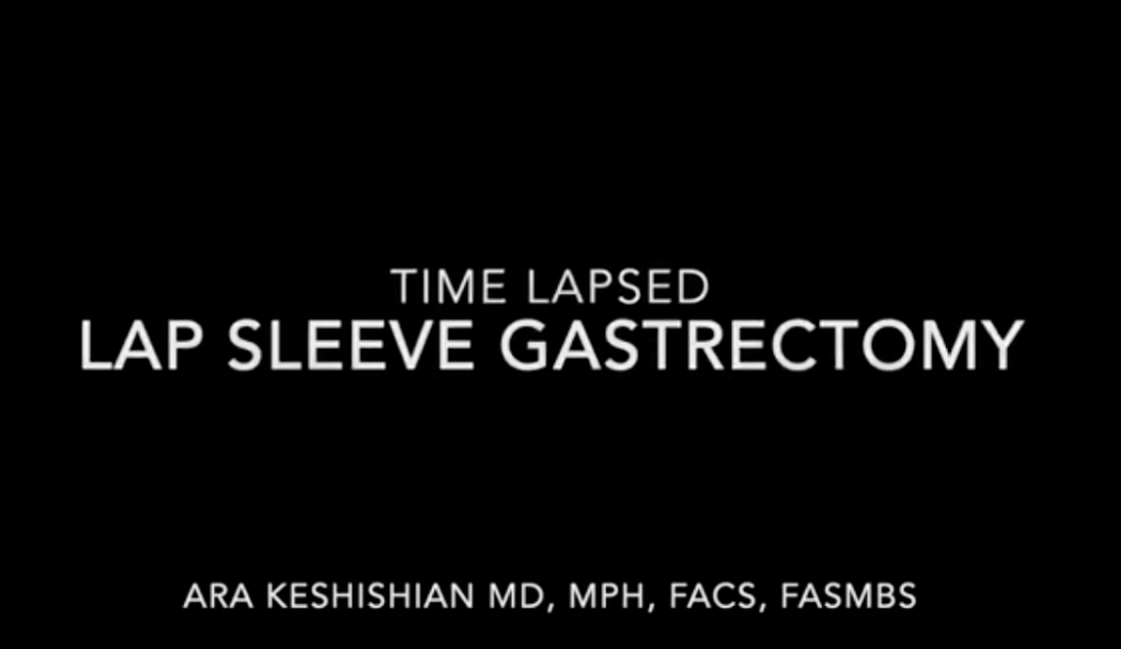 Time Lapsed Sleeve Gasterctomy